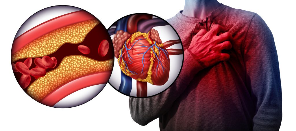 چرا باید آنژیوپلاستی عروق کرونری را انجام بدهیم؟