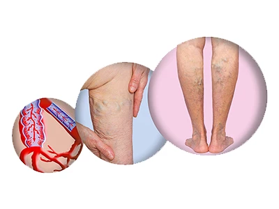 صوره لدوالی خفیفه فی الساقین