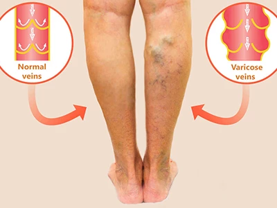 صوره لدوالی خفیفه ومقارنتها بساق صحیه