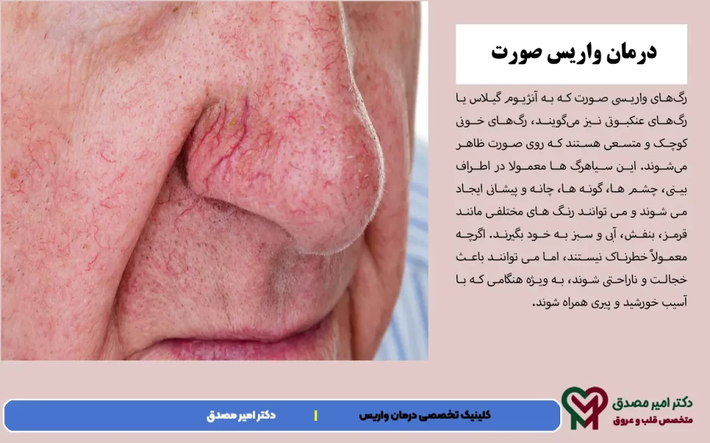 الدوالي من أجل ماذا ؟ علاج الدوالي الوجه