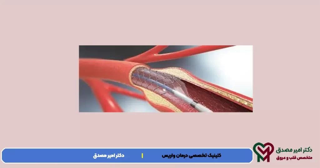 قسطرة هو إجراء طبي لفتح الأوعية التي تعاني من عوائق أو ضيق اقتران أدناه. أثناء الجراحة مع استخدام القسطرة ، إلخ. منطاد الهواء الساخن في الشريان المسدود نضع في مجرى الدم التي ستنشأ. جراحة رأب الأوعية التاجية, في بعض الأحيان كوسيلة الطوارئ بعد نوبة قلبية يتم في بعض الحالات كما في حالة أن الطبيب القلب أن تكون مشبوهة عن خيار الاختيار هو القيام به.