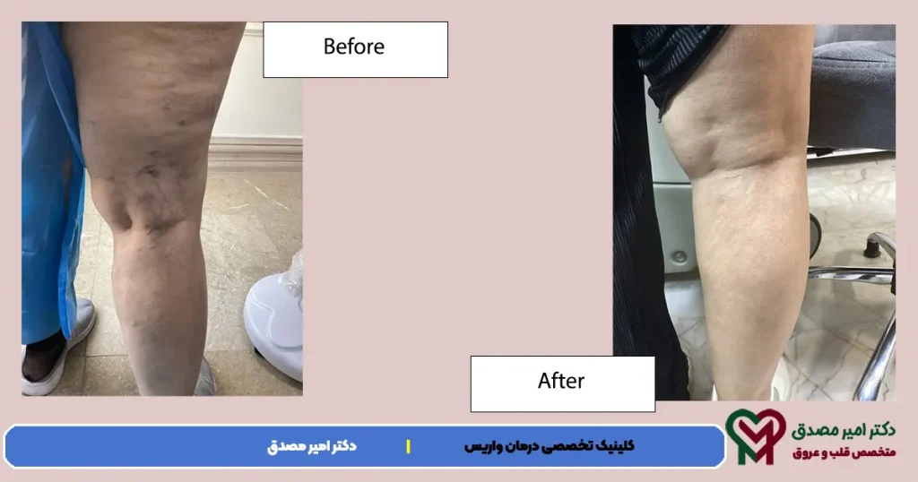 الليزر الدوالي تانابي
