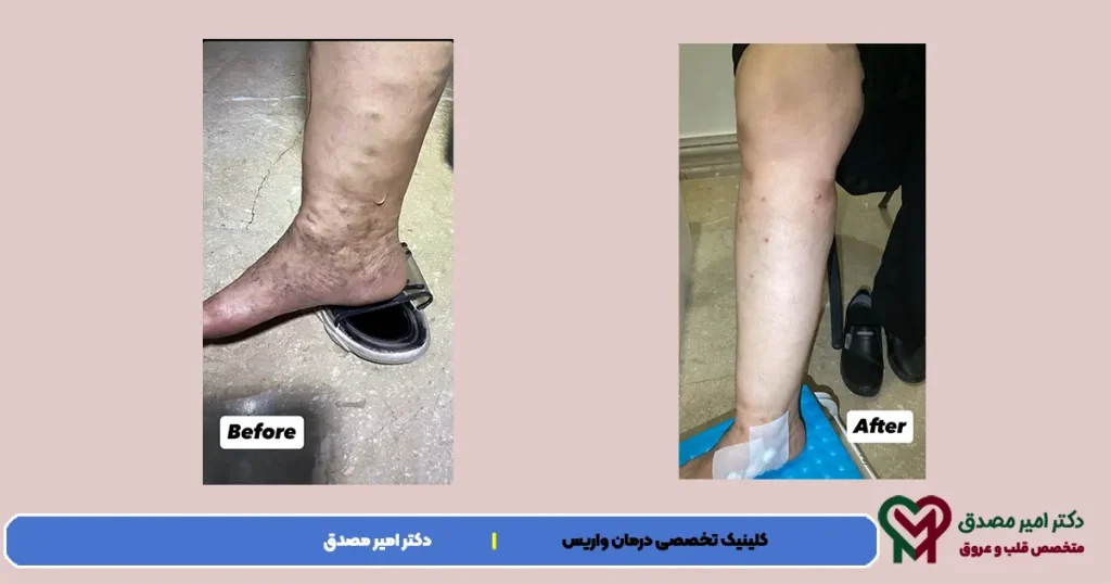 الدوالی العمل ؟